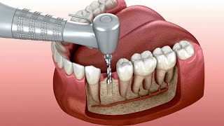 Reconstrucción de muelas y Brackets [upl. by Nivonod]