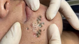 Big Cystic Acne Blackheads Extraction Blackheads amp Milia Whiteheads Removal Pimple Popping  1235 [upl. by Edgar547]