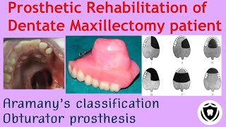 Prosthetic rehabilitation of Dentate Maxillectomy patientPart 1 [upl. by Guyon]