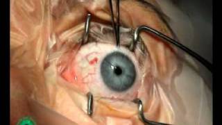 Strabismus Surgery forced duction tests p 256 [upl. by Nylrad]