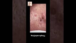 Blackheads Removal  Acne Treatment and Very Satisfying Satisfying Pimple pop blackheads [upl. by Khichabia174]