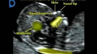 Fetal Medicine Foundation  Nuchal translucency [upl. by Doty259]