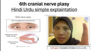 6th cranial nerve palsy in hindi urdu  simple explaintation  cranialnerves plasy [upl. by Ocramed]