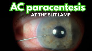 Anterior Chamber Paracentesis  HOW TO to quickly and safely lower elevated eye pressure [upl. by Asabi]