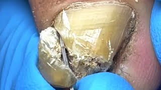 Dirty nails Rare Super Thick Onychomycosis【Pedicure Master Lin Jun】 [upl. by Arand]