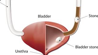 What Are Bladder Stones [upl. by Florance483]