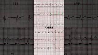 AVNRT ECG Narrow QRS complex [upl. by Pizor375]