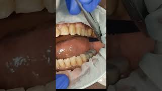 How to check 40 micron clearance for dental implant bridges  shorts [upl. by Anoynek]