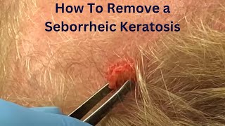 How To Remove a Seborrheic Keratosis [upl. by Notnel]