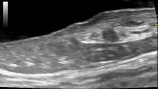 Sonography of distal ureter ureteral papilla and ureteral jet in a dog with pyelonephritis [upl. by Low982]