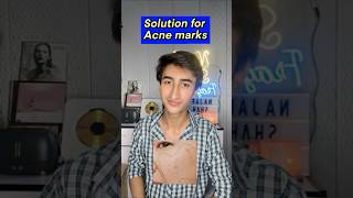 Solution for Acne Marks acne acnetreatment [upl. by Selfridge]