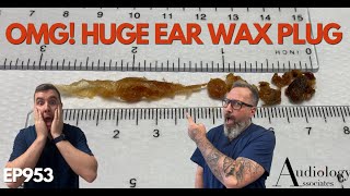 OMG HUGE EAR WAX PLUG REMOVED  EP953 [upl. by Atirahs]