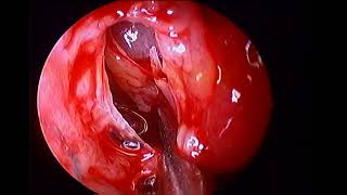 Right maxillary sinus empyema unedited uncinectomy middle meatal antrostomy under local [upl. by Ranilopa]