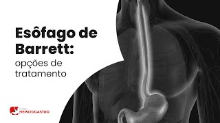 Esôfago de Barrett opções de tratamento  Clínica Hepatogastro [upl. by Haronid]