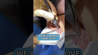 Stretched Ear Lobe repair by Dr F Caron  Clinique Evolution  réparation lobes oreilles [upl. by Rasmussen]