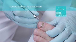 Hilfe für nahezu jeden Problemnagel  RUCK® NAGELKORREKTUR  GOLDSTADT professional Vollspange [upl. by Atnuahc]