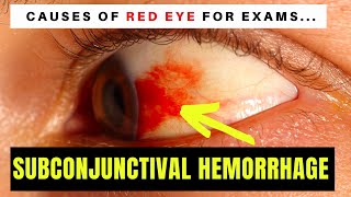 Causes of Red Eye  Part 1 SUBCONJUNCTIVAL HAEMORRHAGE blood on the eyeball [upl. by Wootten615]