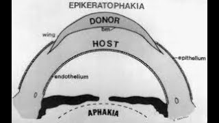 Keratophakia  Corneal Lens  Eye Donation Aphakia  Pseudophakia  Epikeratoplasty Corneal Disc [upl. by Thurmann84]