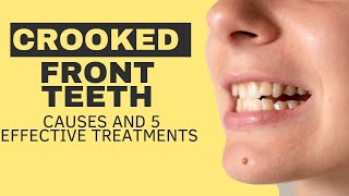 Crooked Front Teeth Causes and 5 Effective Treatments [upl. by Kelson]