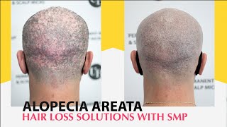 Treating Alopecia Areata with Scalp Micropigmentation [upl. by Neilla144]