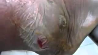 Big Blackhead Squeezed Pimple Removal Cyst Treatment 2015 [upl. by Hentrich]