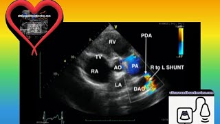 Eisenmengers Syndrome [upl. by Gainor]