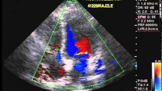 Echocardiography and Color Flow Doppler [upl. by Fellows]