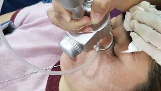 LASER CO2 FRACTIONAL TREATMENT [upl. by Pomfrey850]