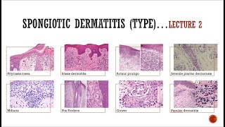 5 Spongiotic Dermatitis 2 [upl. by Tricia396]