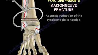 Ankle Fractures  Special Situations  Everything You Need To Know  Dr Nabil Ebraheim [upl. by Dnomayd]