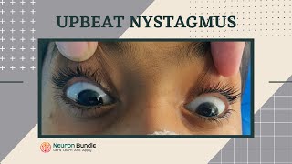 nystagmus  eye movements l demo on a patient l horizontal amp vertical nystagmus neurology [upl. by Nnoved]