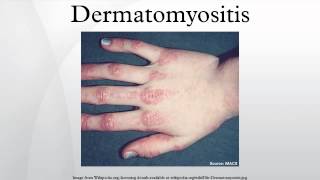 Dermatomyositis [upl. by Sumedocin]