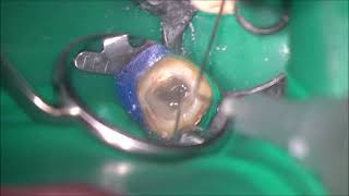 Complete removal of contaminated guttapercha from the Cshaped root canal using ultrasonic device [upl. by Portingale277]