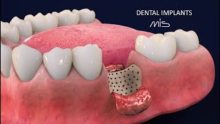 How to Perform Dental Implants by MIS Tutorial 3D Dental Animation [upl. by Kimble207]