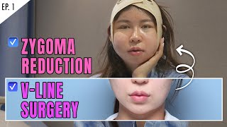 SUB Zygoma and Jawline Reduction Plastic Surgery Review VLOG in KOREA  SLIM amp VLINE FACE [upl. by Walworth702]