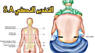 التخدير الشوكيالنصفي Spinal Anesthesia [upl. by Emmanuel698]