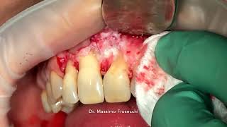 2 roots central incisor with periodontal furcation involvement [upl. by Gustafson]