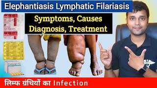 Elephantiasis  Filariasis  Symptoms Causes Diagnosis Treatment Prevention In Hindi [upl. by Yenhoj122]