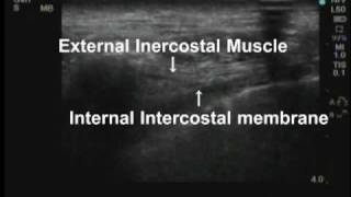 Ultrasound guided Thoracic paravertebral block with a HFL50 probe [upl. by Esenwahs]