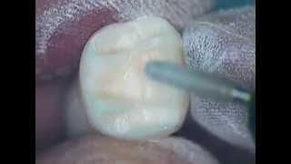 Crown Preparation Tooth Number 30 Part 1 [upl. by Clarkin400]