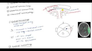 Epidural Hematoma Subdural hematoma Subarachnoid hematoma Intracerebral hemorrhage [upl. by Anilat]