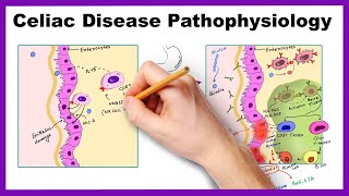 Celiac Disease Pathophysiology Simplified [upl. by Xanthus]