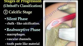 Calcific Tendonitis  Everything You Need To Know  Dr Nabil Ebraheim [upl. by Nodnorb]