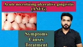 ANUG Acute necrotizing ulcerative gingivitis [upl. by Leis869]