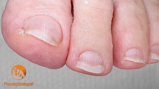 Podology for diabetic patientsEffects in the grooves due to long nails Documenting podology cases [upl. by Polk141]