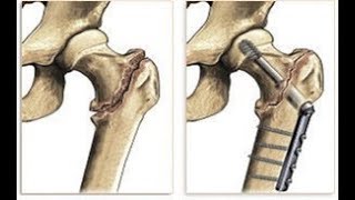 هل يمكن أن تلتئم الكسور فى الكبار trochanteric fractures DHS [upl. by Ecyrb]