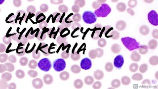 Chronic Lymphocytic Leukemia CLL Peripheral Blood Smear Hemepath Hematology Pathology [upl. by Mcquoid213]