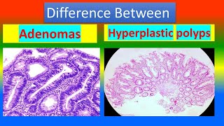 Difference between Adenomas and Hyperplastic Polyps [upl. by Aissatsan]