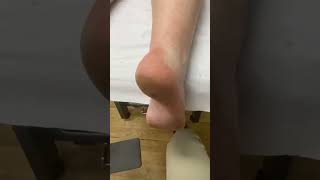 Relief from Painful Heel Callus Expert Removal by Australian Podiatrist [upl. by Asaret127]