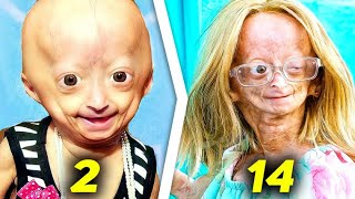 Who Is The Girl Who Grows Old Fast  Adalia Rose Williams [upl. by Carmelia]